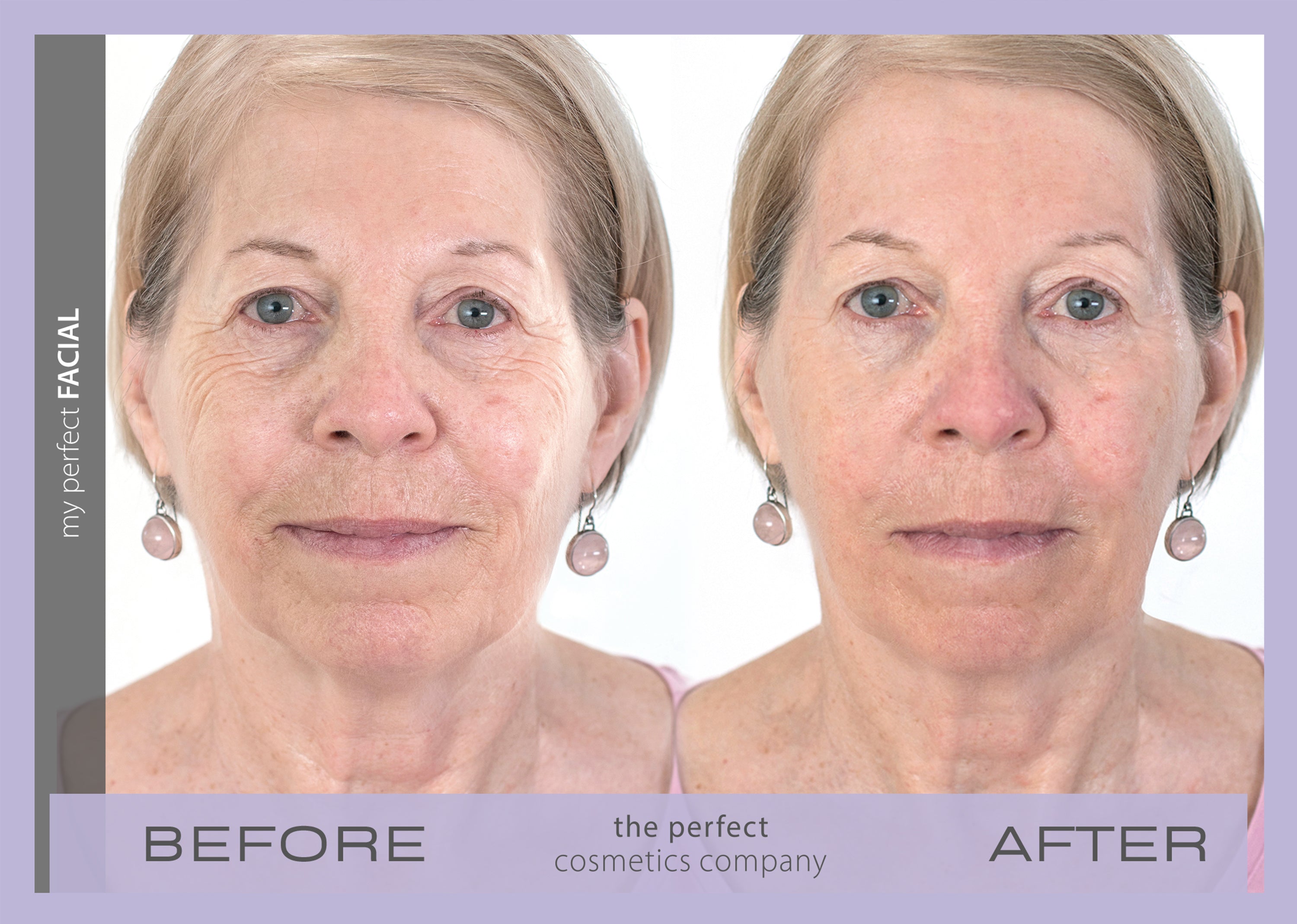 My Perfect Facial before and after results showing visible skin tightening and reduced wrinkles, delivering non-surgical facial rejuvenation for a youthful appearance.